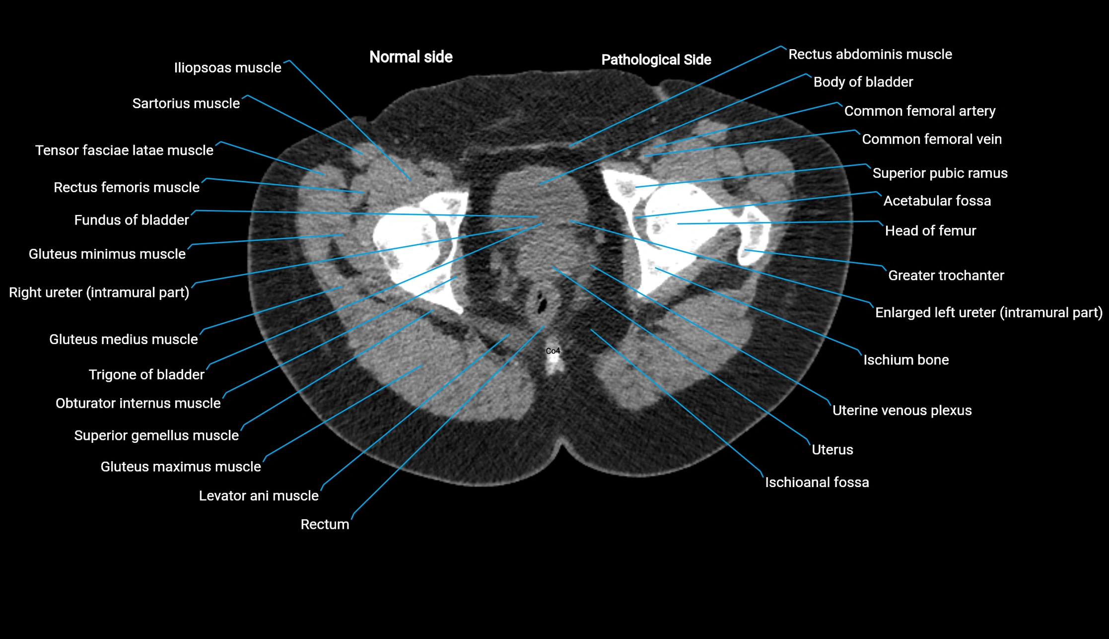 CT KUB axial cross sectional anatomy  radiology image -img-00201-00161.webp